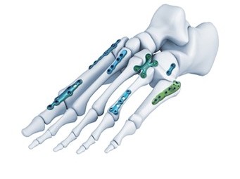 Orthopedic surgical instruments